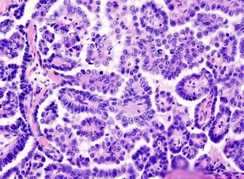 新研究发现帮助清除癌症干细胞的新靶标